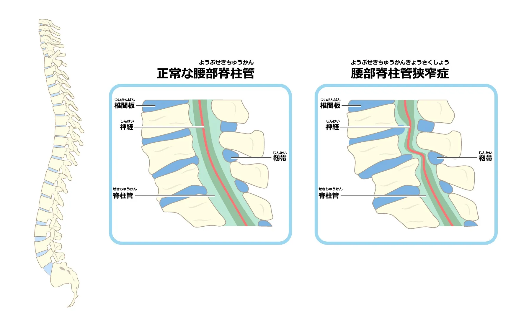 【脊柱管狭窄症】の原因と治療方法について｜姫路 鍼灸・整骨 つなぐ