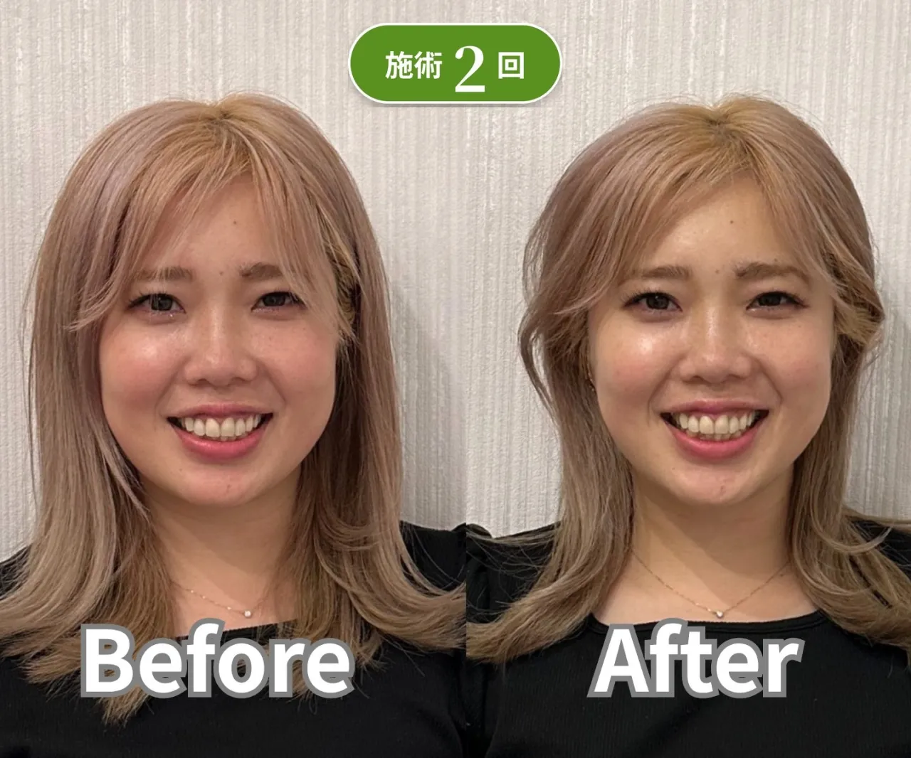美容鍼を続けた結果 2回 ビフォーアフター 症例1 姫路 鍼灸・整骨つなぐ