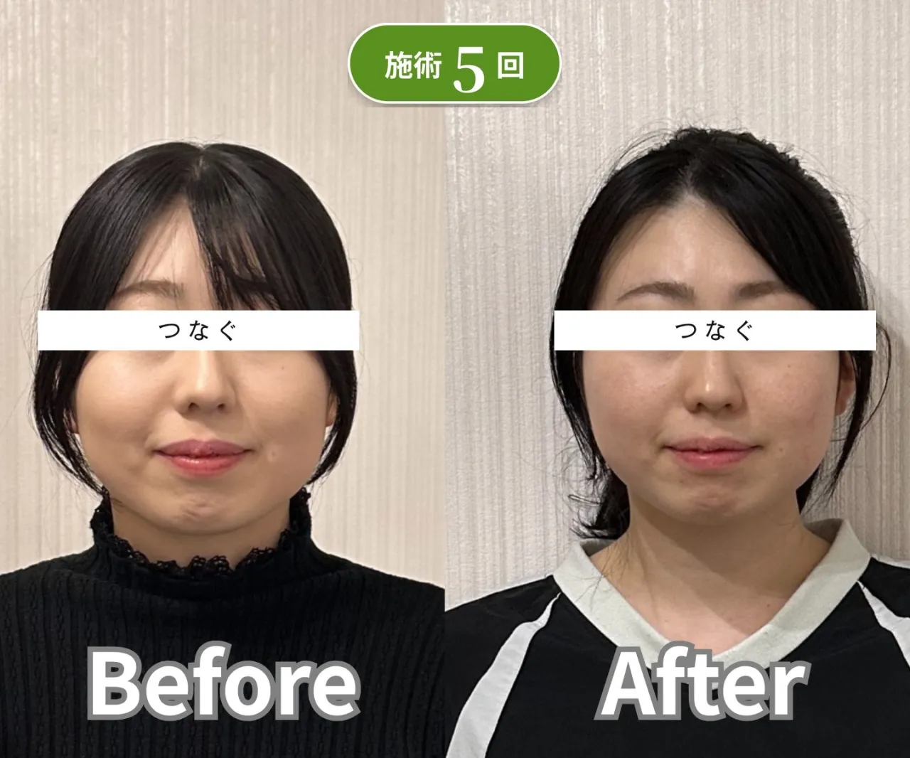 美容鍼 5回 ビフォーアフター 症例2 フェイスライン 姫路