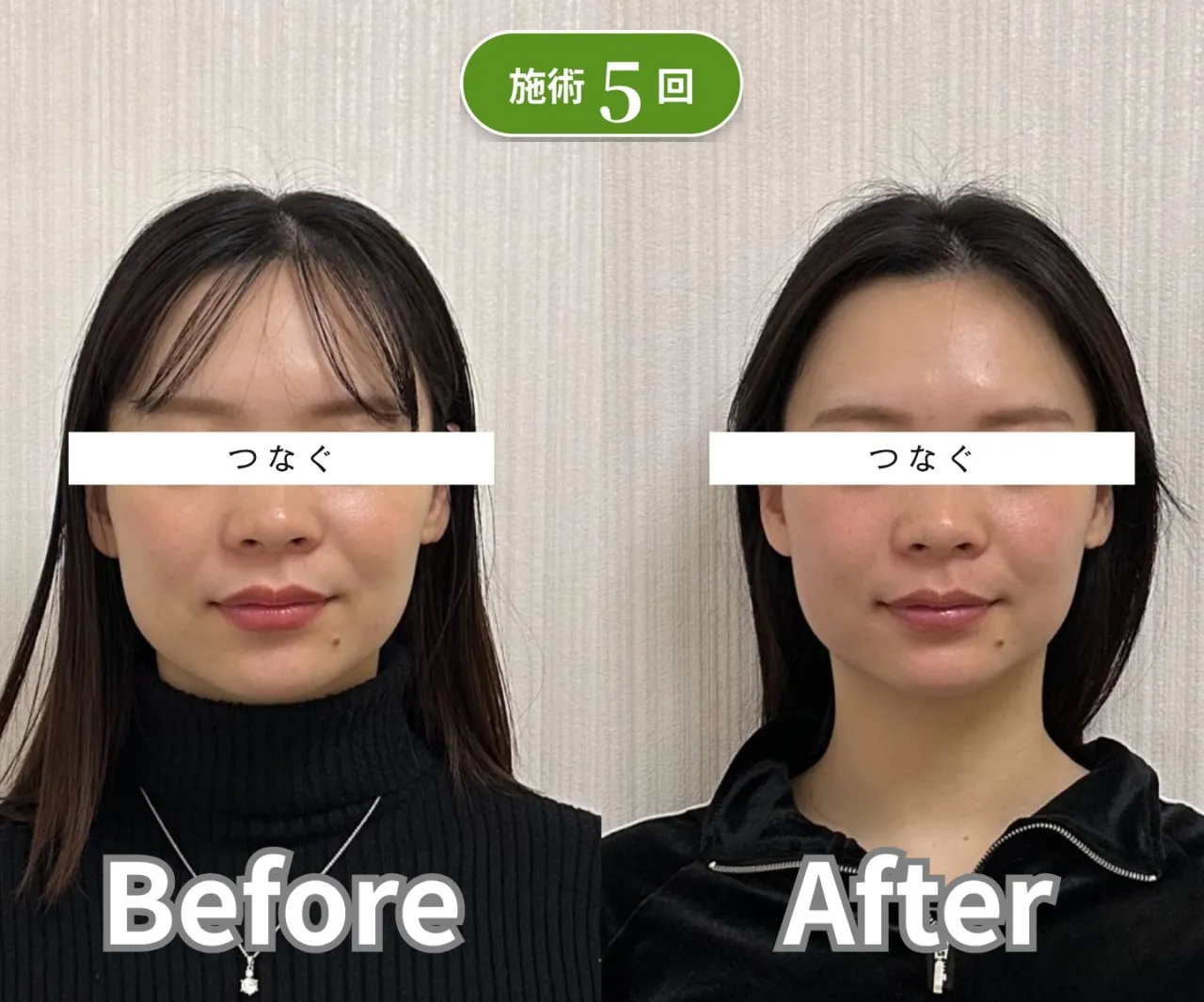 美容鍼 5回 ビフォーアフター 症例3 リフトアップ 姫路